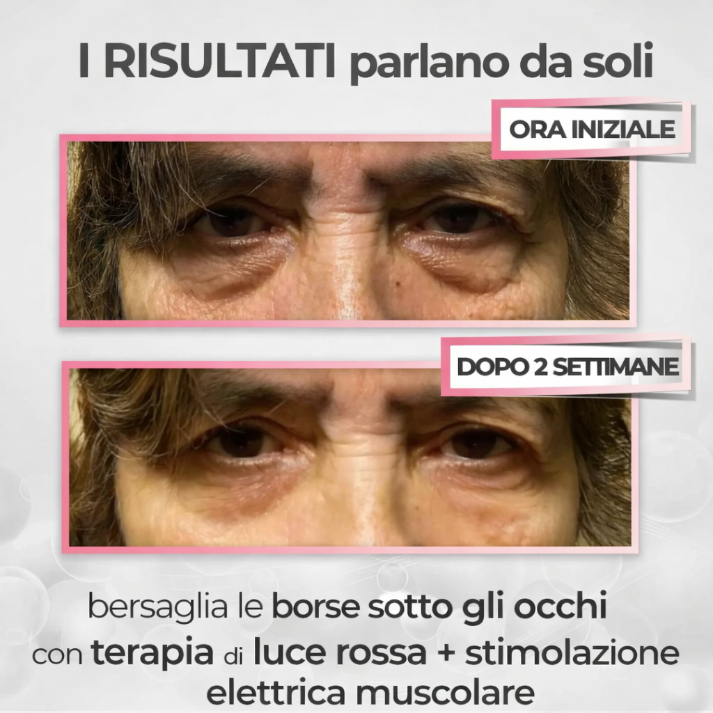 LunaBella® 2-in-1: Luce Rossa + EMS per Eliminare le Borse sotto gli Occhi